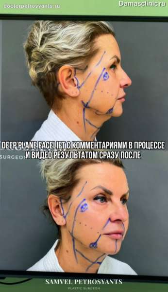 DEEP PLANE FACELIFT с комментариями в процессе, видео и фото-результатом сразу после